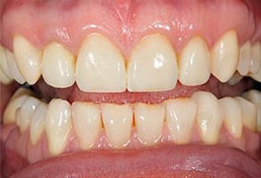 The image shows a close-up view of a person s teeth with a focus on their yellowish coloration, which suggests possible dental issues such as staining or decay.